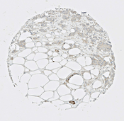IHC of breast cancer cells labeled with DSHB antibody CPTC-CRP-1 against C-Reactive Protein Peptide 1. Image Credit: NCI-Clinical Proteomic Technologies for Cancer.